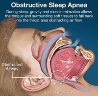 6684186c74b021d34b0a1fb2 obstructive sleep apnea1 e1447178863399