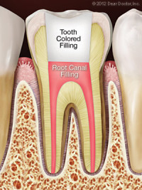 6684186c74b021d34b0a1fe6 after root canal1 e1447177497717