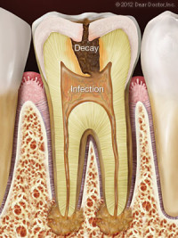 6684186c74b021d34b0a1fee tooth decay infection1 e1447177100910