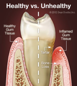6684186c74b021d34b0a2140 periodontal disease e1447179371925