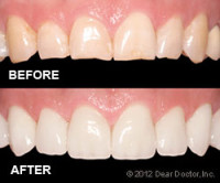 6684186c74b021d34b0a2152 veneers before after1 e1447175398700
