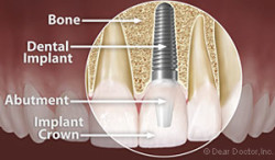 6684186c74b021d34b0a2154 dental implant anatomy1 e1447178999624