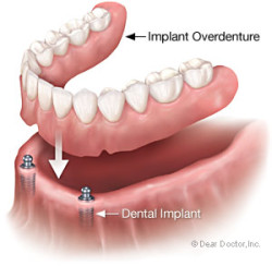 6684186c74b021d34b0a2157 implant overdenture1 e1447179185678