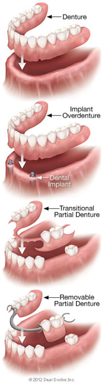 6684186c74b021d34b0a215a removable denture types 214x792
