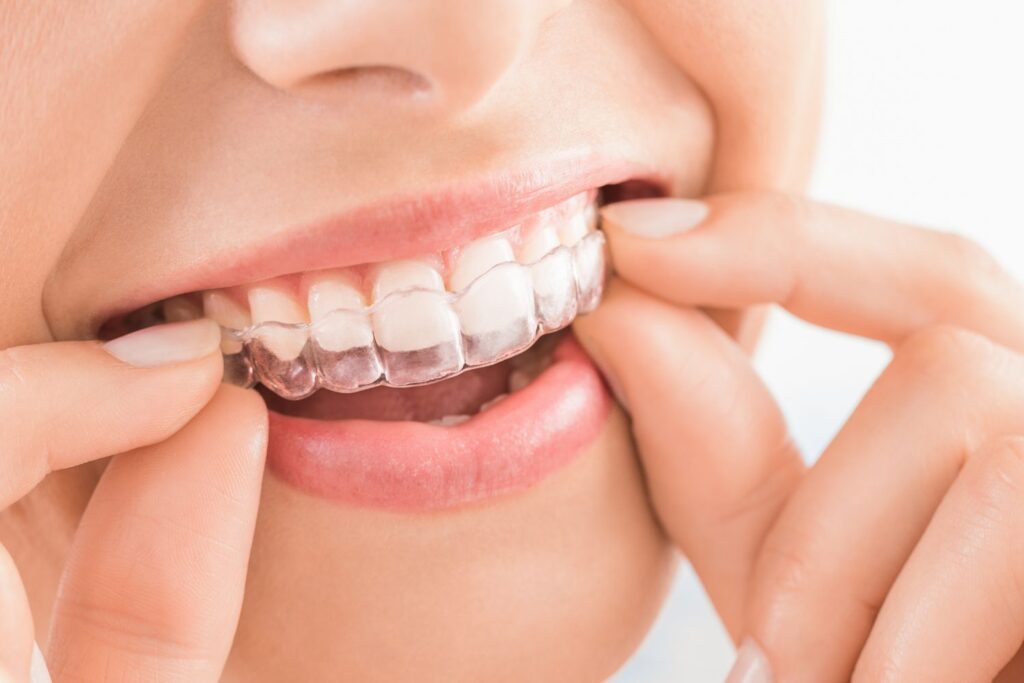 6684186c74b021d34b0a21a0 invisalign20or20braces 1