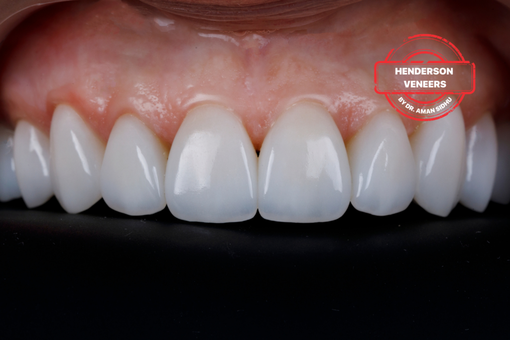 6684186c74b021d34b0a21af How20Henderson20Veneers20by20Dr.20Aman20Sidhu 2 1